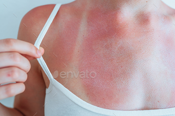 Swimsuit strap marks on younger girl’s sunburned pores and skin